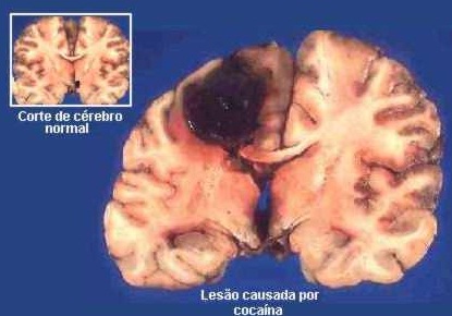 danios-cerebrales.causados-por-cocaina