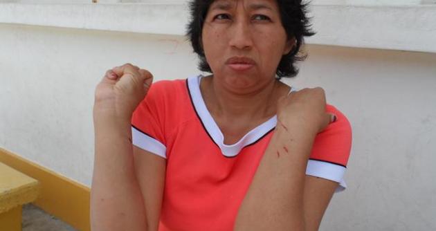 La médico María Mejía llegó a laborar al Hospital de Casma resultó con heridas.